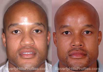 front view Male before and after Rhinoplasty