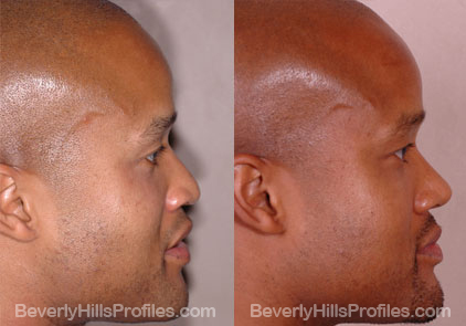 side view Male before and after Rhinoplasty