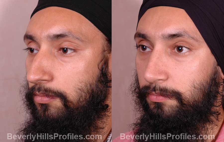 oblique view - Male before and after Rhinoplasty