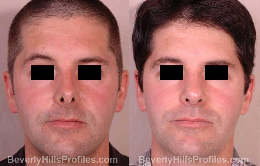 front view - Male patient before and after Nose Job