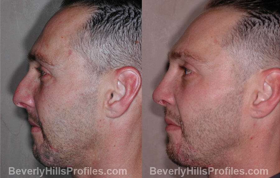 side view - Male before and after Nose Job