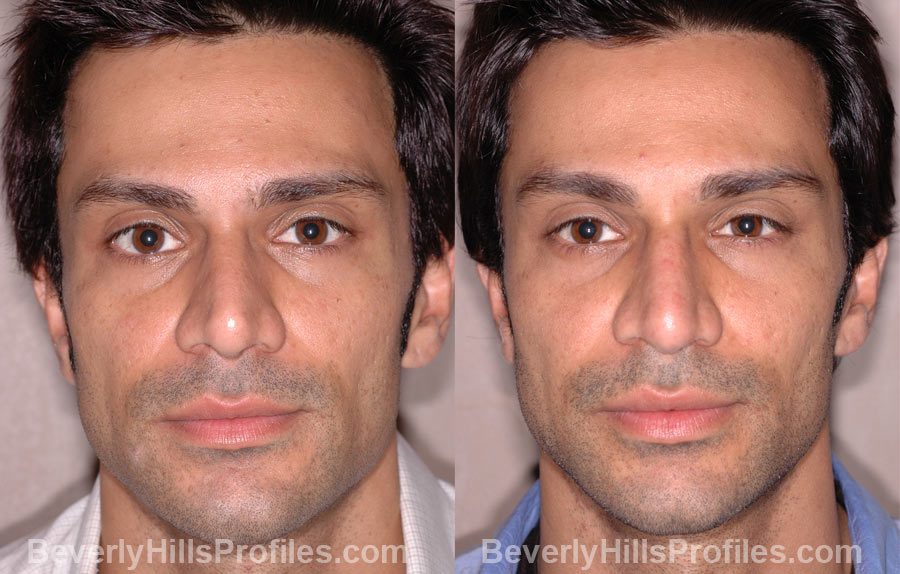 Male before and after Nose Job - front view