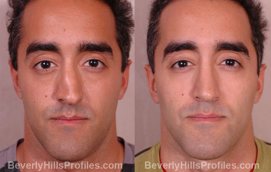 Revision Rhinoplasty Before and After Photo Gallery - front view, male patient 20