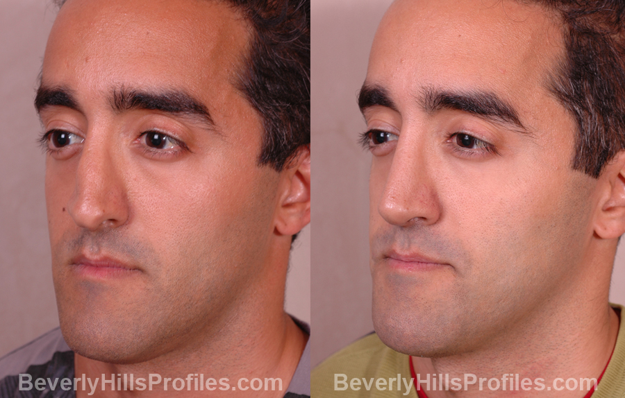 Male patient before and after Nose Job oblique photos