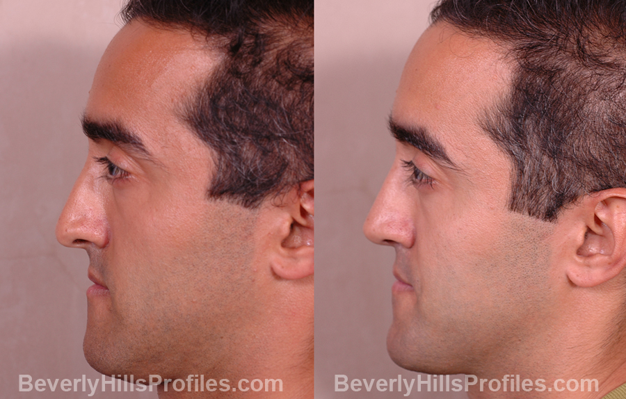 Male patient before and after Nose Job side photos