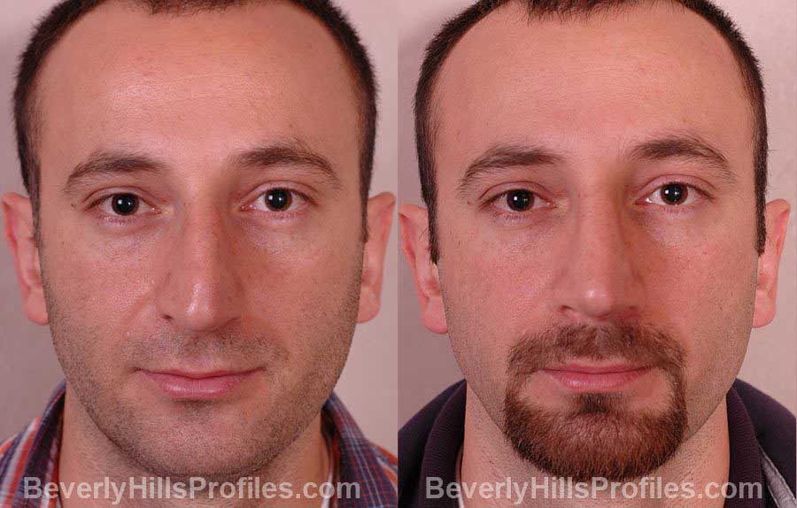 pics Male before and after Nose Job - front view