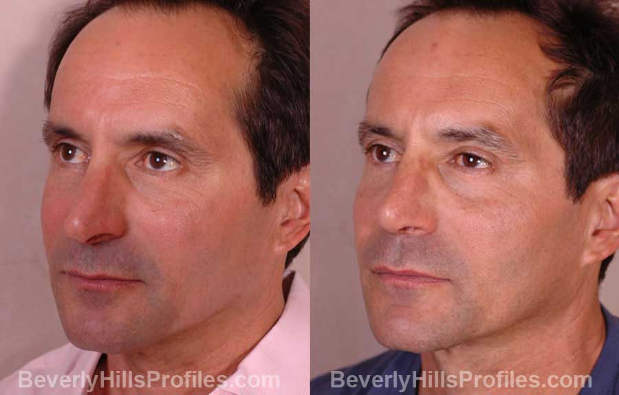 imgs Male before and after Nose Job - oblique view
