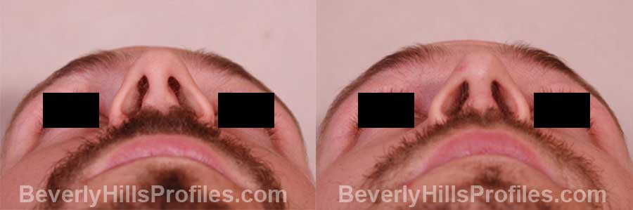 pics Male before and after Nose Job underside view