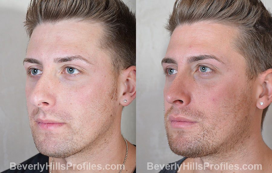 Male patient before and after Rhinoplasty - oblique view