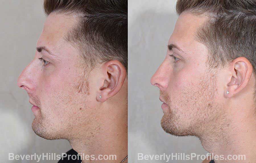 Male patient before and after Rhinoplasty - side view