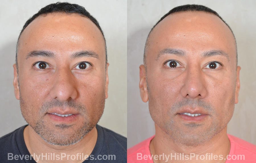 Male before and after Nose Surgery front view