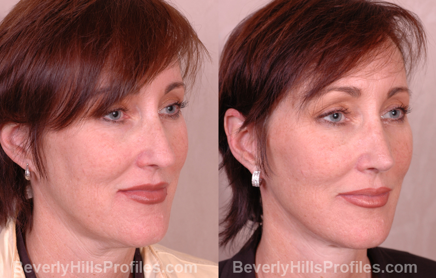 photos before and after Necklift - oblique view