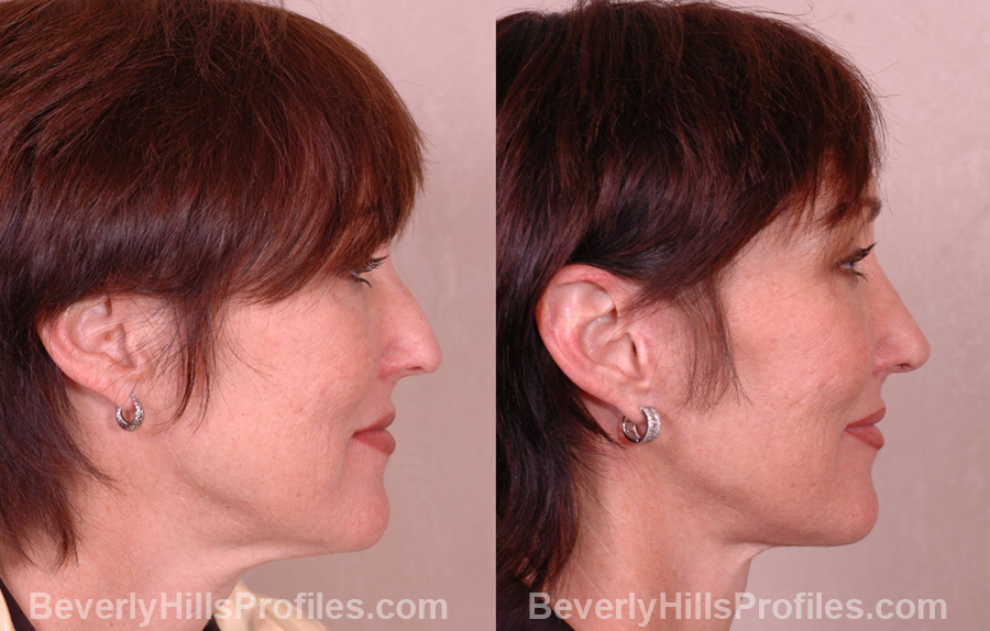 photos before and after Necklift - right side view