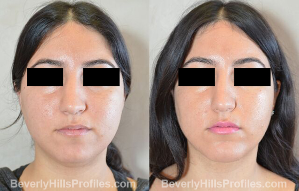 photos before and after Necklift Procedures - front view