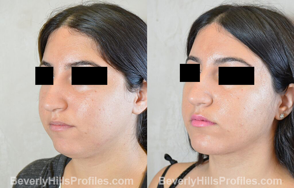 photos before and after Necklift Procedures - oblique view