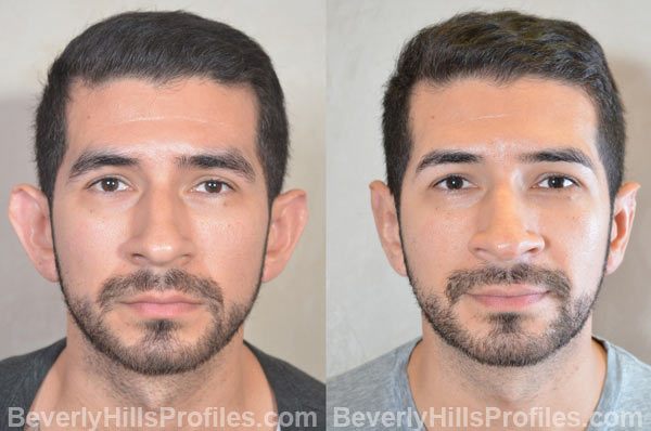 photos male patient before and after Otoplasty - front view