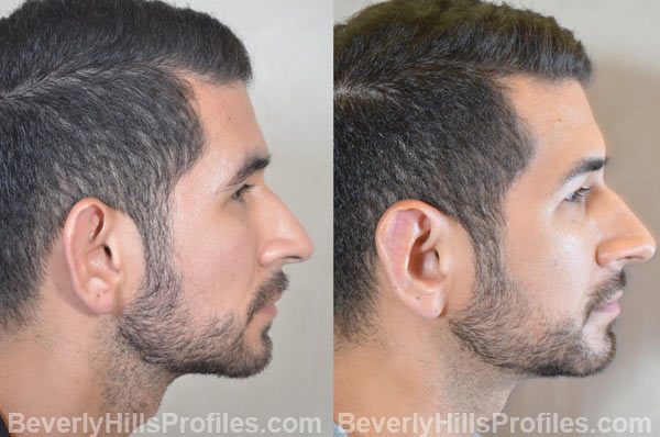 photos male patient before and after Otoplasty - right side view