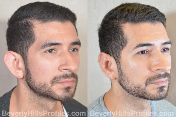 photos male patient before and after Otoplasty - oblique view
