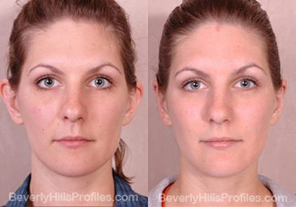 photos female patient before and after Otoplasty - front view