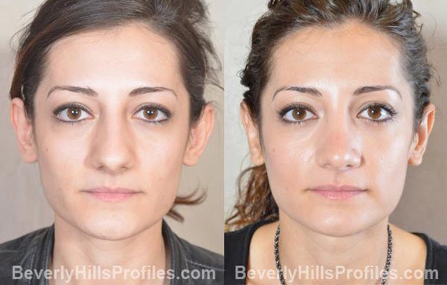 front photos - Female before and after Otoplasty