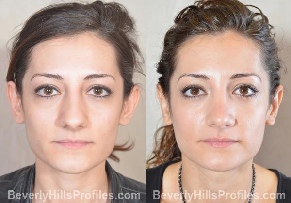 female patient before and after Otoplasty - front view