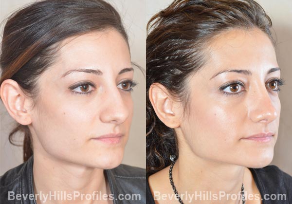 female patient before and after Otoplasty - oblique view