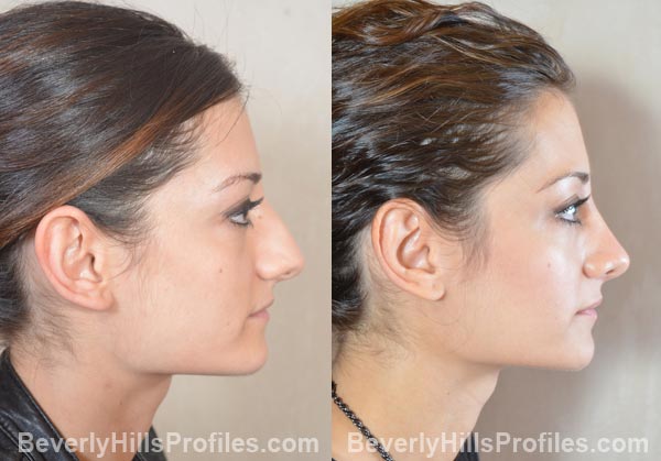 female patient before and after Otoplasty - right side view