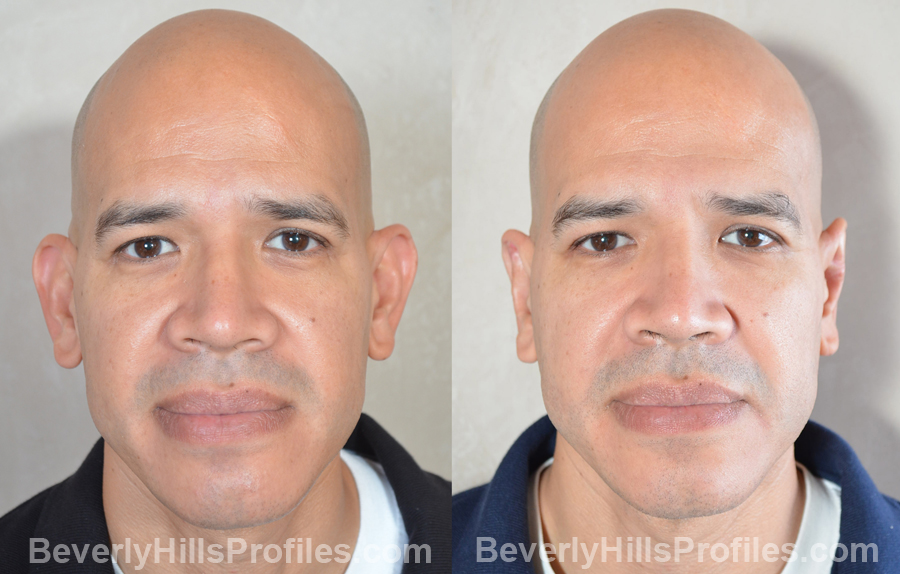 male patient before and after Otoplasty Procedures - front view