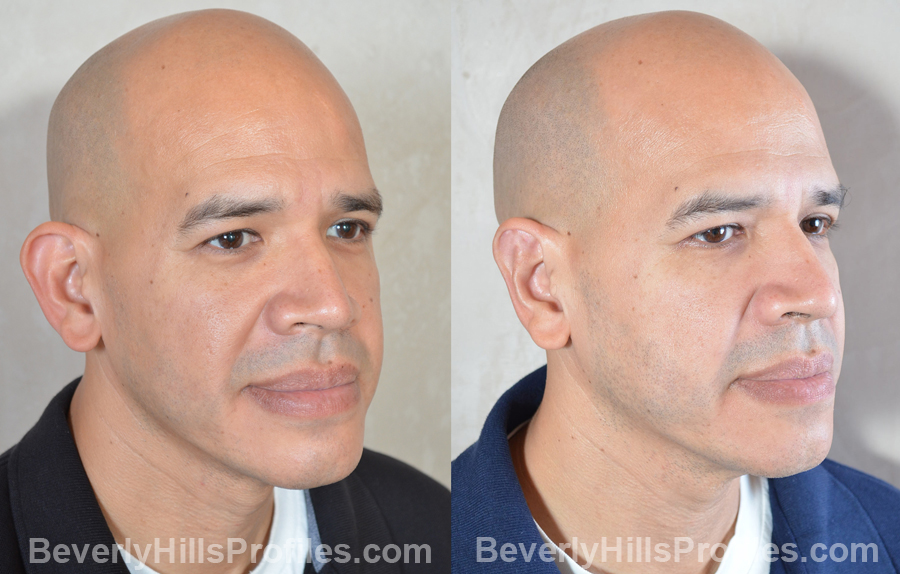 male patient before and after Otoplasty Procedures - oblique view
