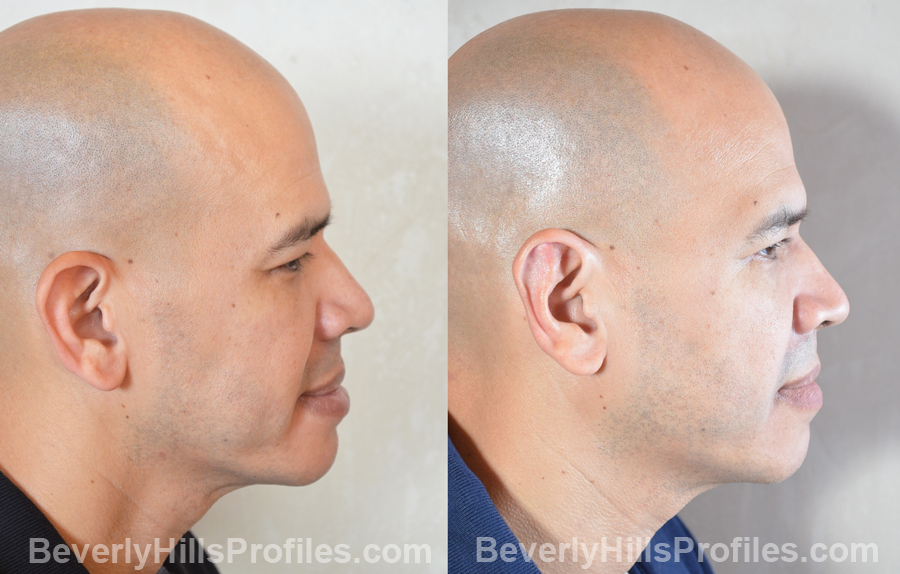 male patient before and after Otoplasty Procedures - right side view