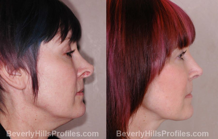 Revision Rhinoplasty Before and After Photos - female, right side view, patient 1