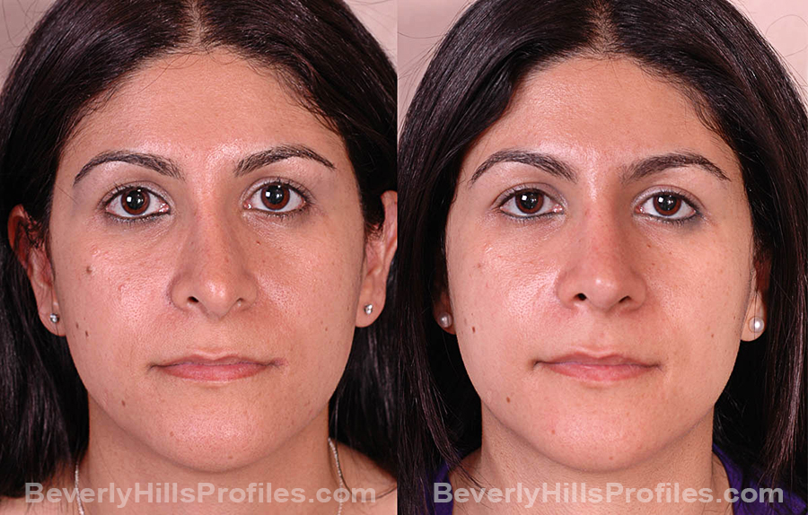 Photos Female before and after Revision Rhinoplasty, front view