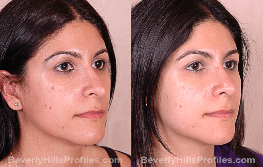 Photos Female before and after Revision Rhinoplasty, oblique view