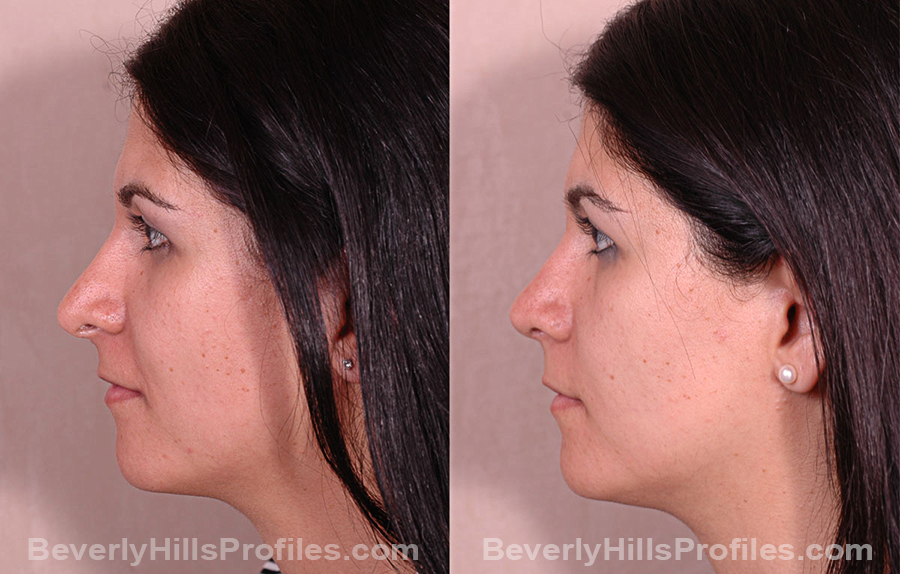 Photos Female before and after Revision Rhinoplasty, side view