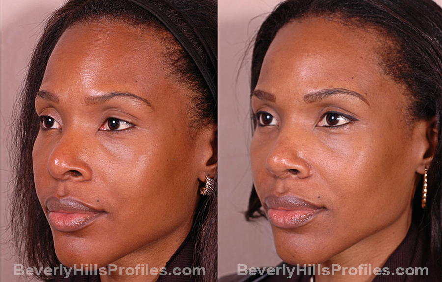 Images Female before and after Revision Rhinoplasty, oblique view