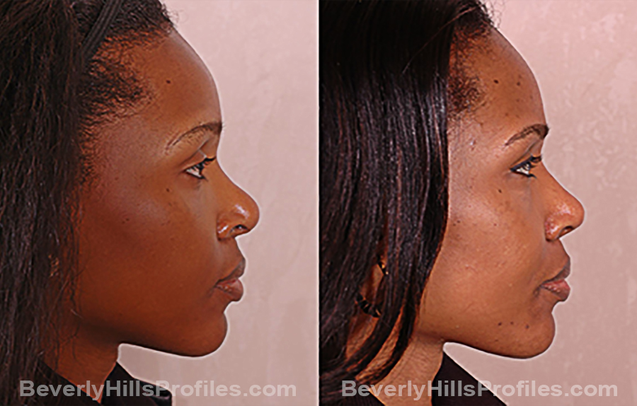 Images Female before and after Revision Rhinoplasty, side view