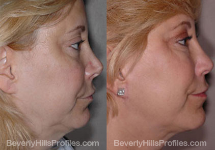 Images patient before and after Revision Rhinoplasty, side view