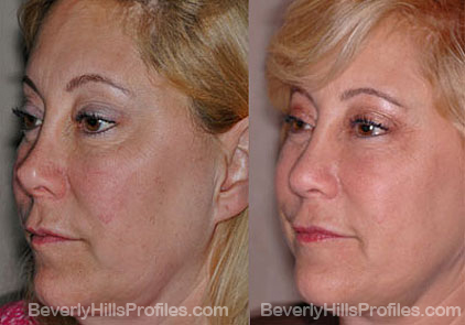Images patient before and after Revision Rhinoplasty, oblique view
