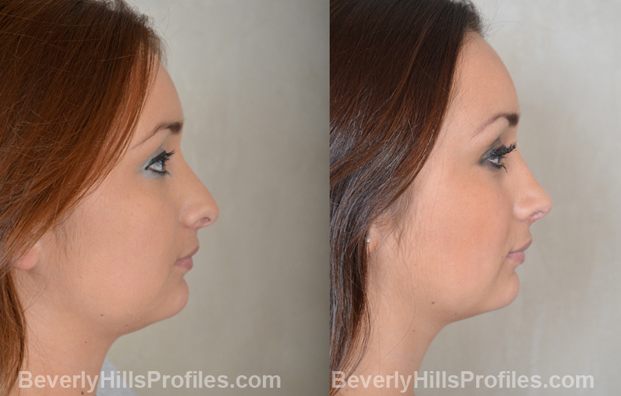 Images Female patient before and after Revision Rhinoplasty - side view