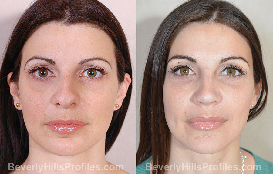 Images Female patient before and after Revision Nose Surgery - front view