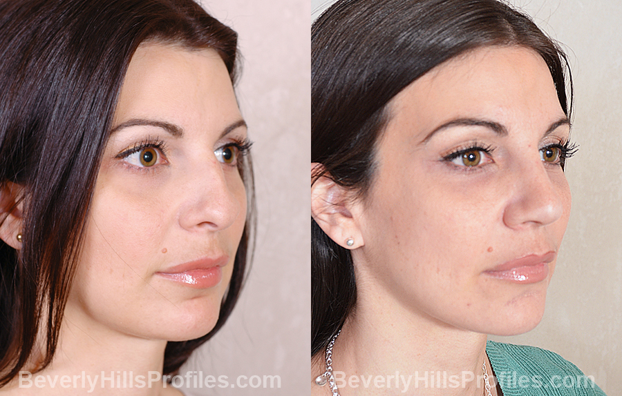 Images Female patient before and after Revision Nose Surgery - oblique view