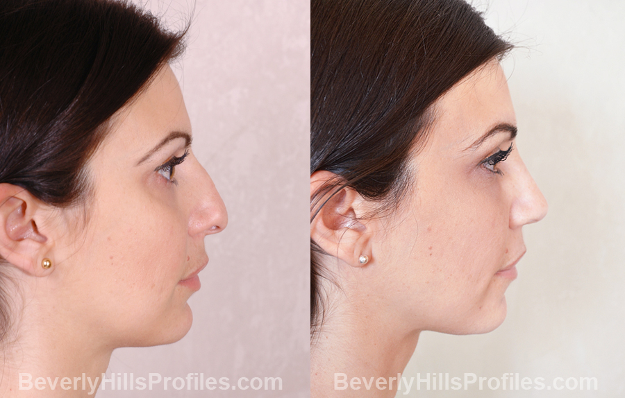 Images Female patient before and after Revision Nose Surgery - side view