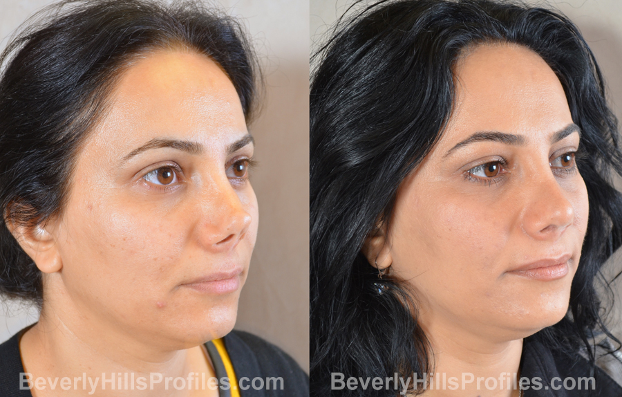 Female patient before and after Revision Rhinoplasty - oblique view