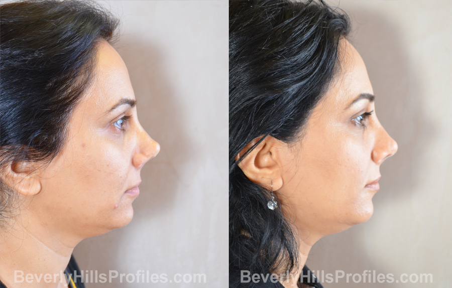 Female patient before and after Revision Rhinoplasty - side view