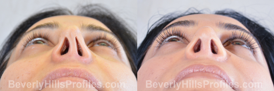 Female patient before and after Revision Rhinoplasty - underside view