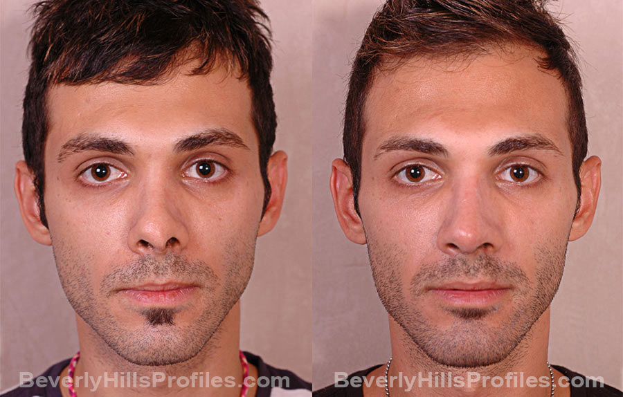 Male patient before and after Revision Rhinoplasty, front view