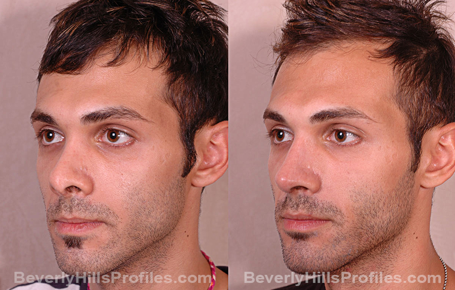 Male before and after Revision Rhinoplasty, oblique view