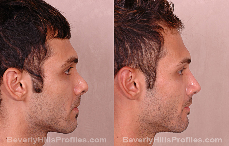 Revision Rhinoplasty Before and After Photo Gallery - male, side view