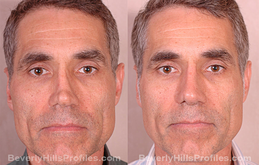 front view Male before and after Revision Rhinoplasty