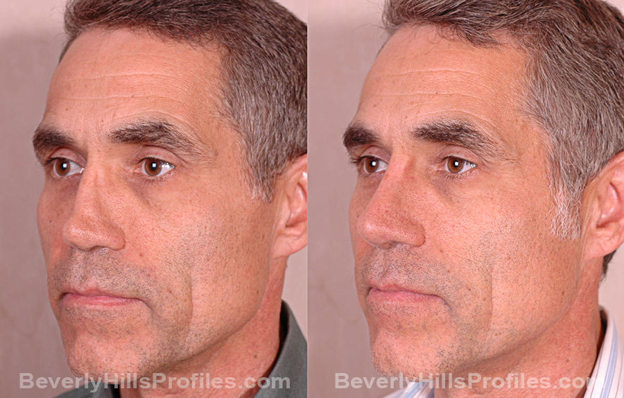 oblique view Male before and after Revision Rhinoplasty